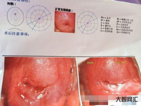 宮頸糜爛有什么癥狀-宮頸糜爛會導致宮頸出血?它還不需要治療?