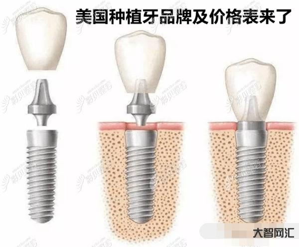 種植牙多少錢一顆2023年-種植牙降價啦!說說種植牙價格那些事