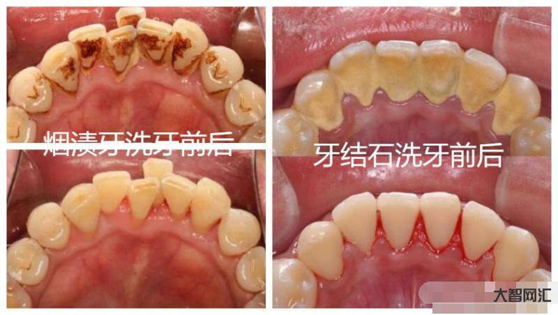 洗牙齒有什么好處和壞處-“洗牙”對牙齒有傷害嗎?醫生:6類人群盡量別洗